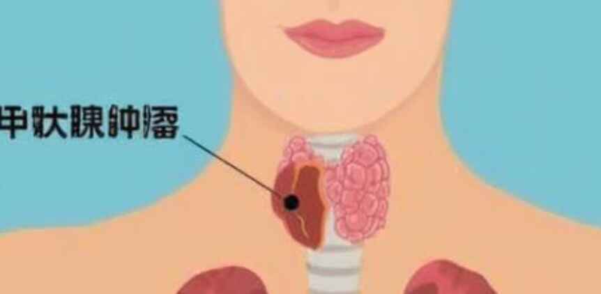 破解甲状腺肿瘤手术迷雾：从诊断到治疗全解析封面图