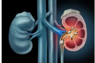全面了解与管理肾绞痛