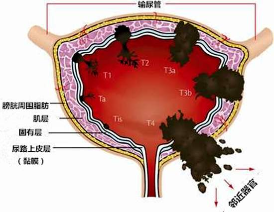 膀胱肿瘤：从诊断到治疗的全面解析