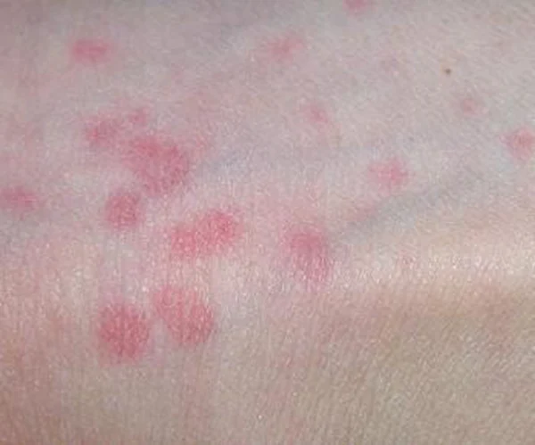 皮炎的科学解读:性质、诊断与治疗策略