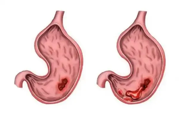 萎缩性胃炎:为什么你需要关注你的胃健康!