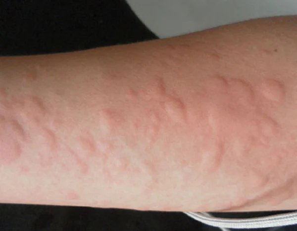 慢性荨麻疹——你是否也被“透明怪”困扰?