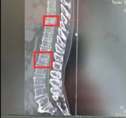 微创手术拯救你的脊椎!新鲜爆裂骨折究竟是怎么回事?