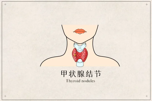 全面解析甲状腺结节:诊断与治疗策略