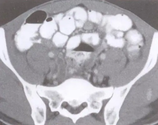 马虎不得:急性阑尾炎并发症与预防!