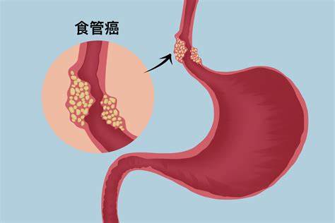 食管癌：早期症状识别、治疗方式及预防方法