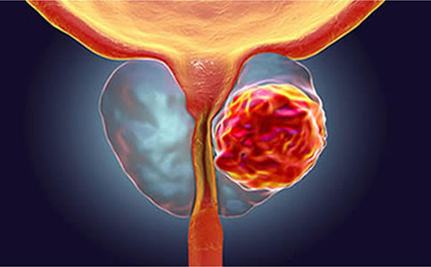 认识前列腺增生：从发病机制到治疗管理全解析