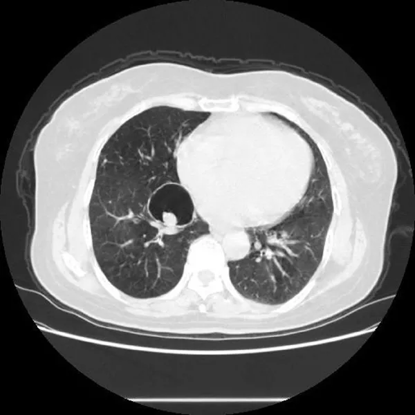 邵女士的肺炎康复之路皆因这些药物——见证治愈的奇迹!