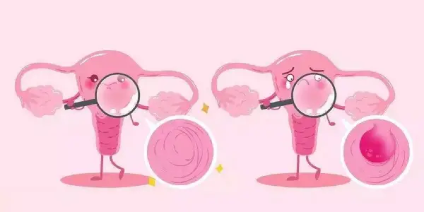 子宫内膜炎:女性健康的隐形威胁