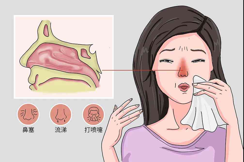 抗击变应性鼻炎，了解富马酸卢帕他定片的奥秘！封面图