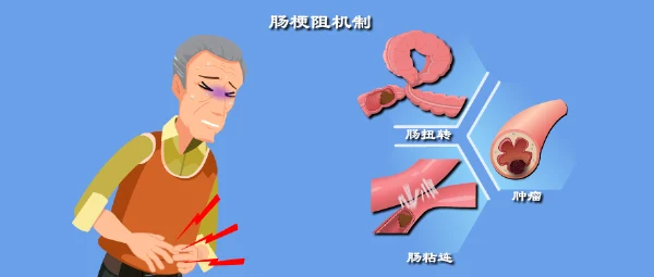 警惕肠梗阻及相关病症!老年人健康不容忽视