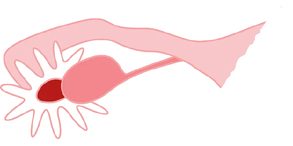 女性盆腔炎和卵巢黄体破裂的全面解读：病因、诊断与治疗