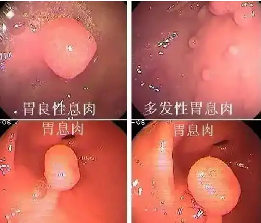 警惕消化系统的隐藏杀手——多发性息肉及其潜在危害！封面图