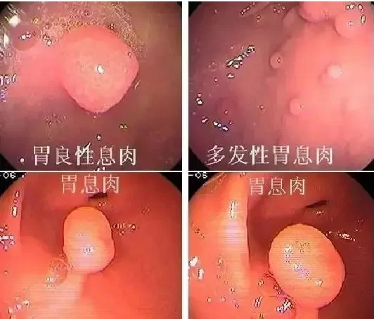 警惕消化系统的隐藏杀手——多发性息肉及其潜在危害!