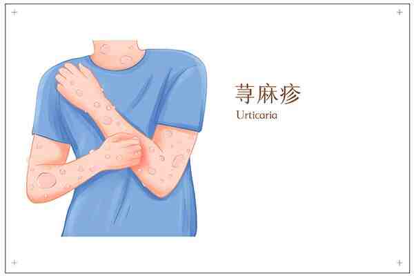 急性<span style="color: #da4707">荨麻疹</span>：了解、预防与<span style="color: #da4707">治疗</span>