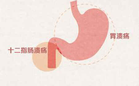 十二指肠溃疡：深入了解及科学管理封面图