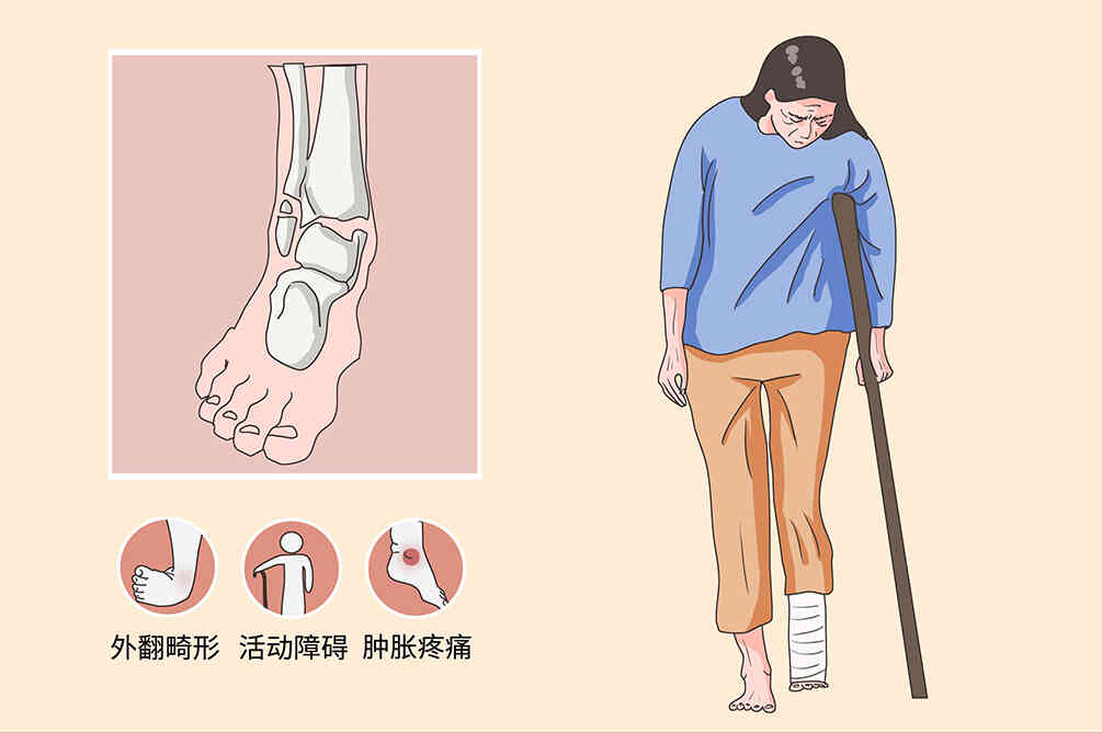 左胫腓骨骨折的医学科普——全面了解及科学应对！封面图