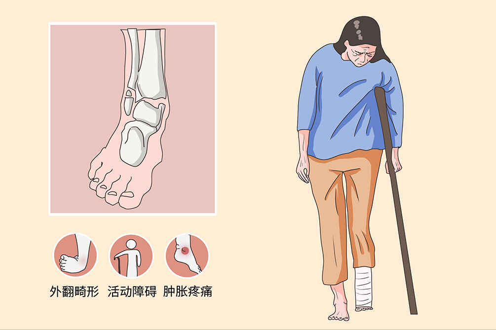左胫腓骨骨折的医学科普——全面了解及科学应对！封面图