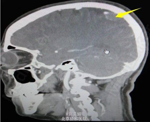 颅内占位病变—你需要知道的一切!