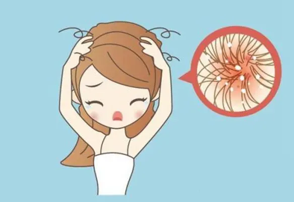 脂溢性皮炎的全面解读及科学用药！