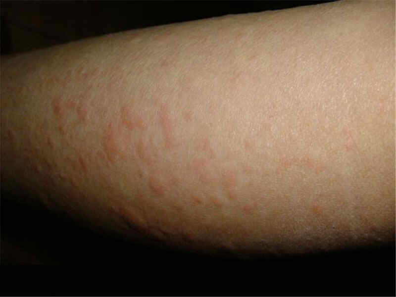 慢性荨麻疹：如何理解、治疗与预防封面图