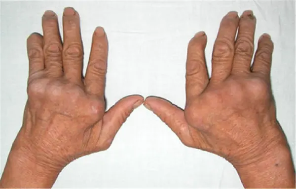 别让类风湿性关节炎成为生活的绊脚石！