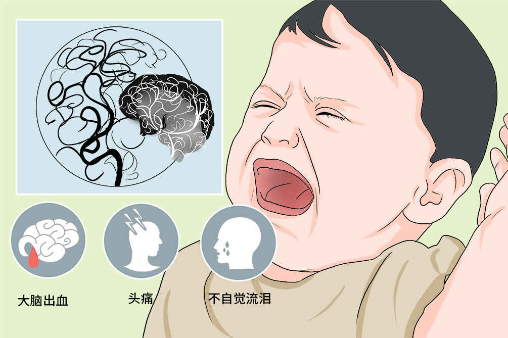 烟雾病：病因、诊断与治疗全解析