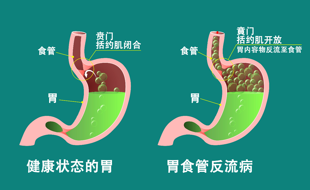 反流性食管炎与慢性胃炎：了解它们，关注你的消化健康