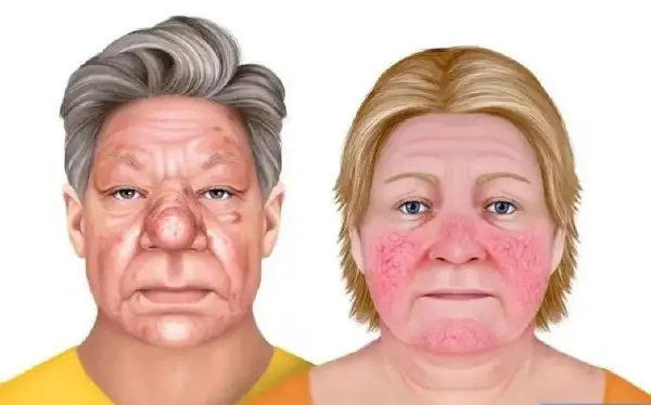 脂溢性皮炎与痤疮：皮肤健康的“双敌”