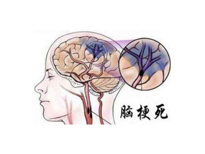 远离糖尿病和脑梗死的双重威胁——老年人如何保护自己！封面图