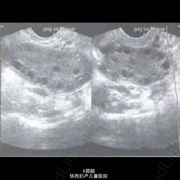 多囊卵巢综合征：从诊断到管理的全面解读