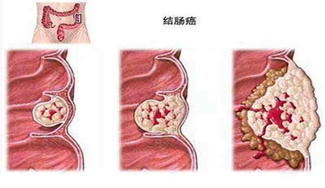 告别肠道“怪兽”——老年人如何应对结肠癌侵袭！