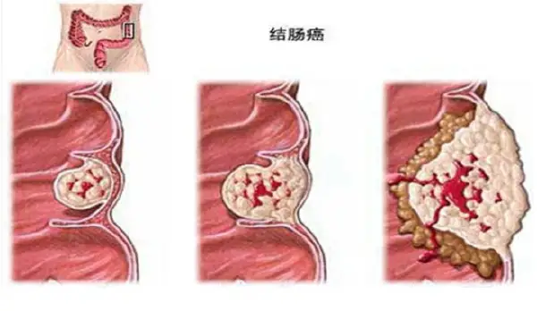 告别肠道“怪兽”——老年人如何应对结肠癌侵袭!