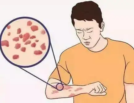 过敏性皮炎：生活中的“隐形杀手”