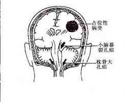 颅内占位病变与脑疝的诊断与治疗：综合分析