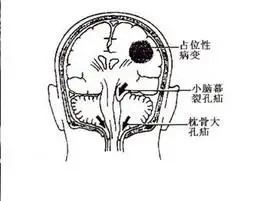 颅内占位病变与脑疝的诊断与治疗:综合分析