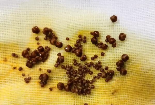 胆结石：不可忽视的健康威胁