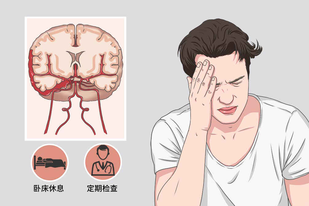 蛛网膜下腔出血：病因、诊断与治疗全面解析