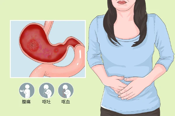 了解慢性胃炎:从病因到预防