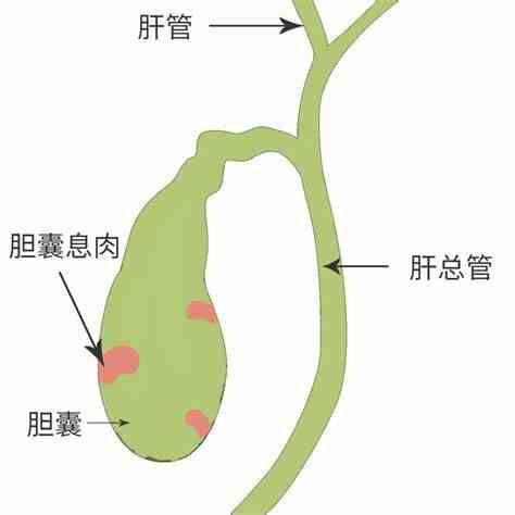 胆囊炎与胆囊结石：深入解析及综合管理封面图