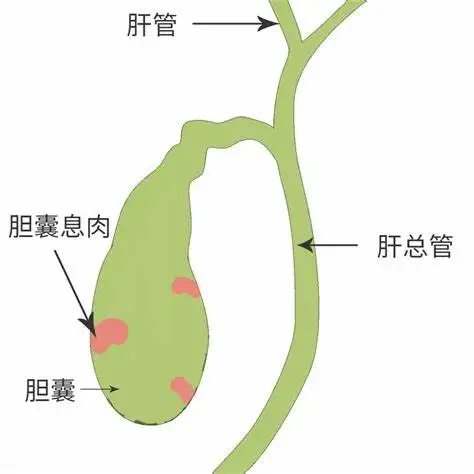 胆囊炎与胆囊结石:深入解析及综合管理