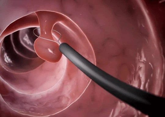 你可能不知道的健康杀手——直肠息肉