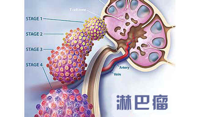 勇敢面对大b淋巴瘤：如何预防和治疗