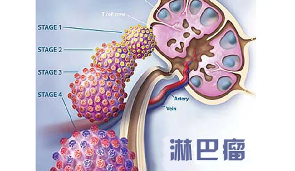 勇敢面对大b淋巴瘤：如何预防和治疗