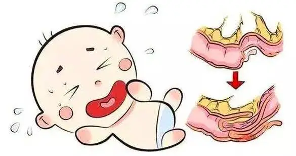 了解小儿结肠炎及其管理