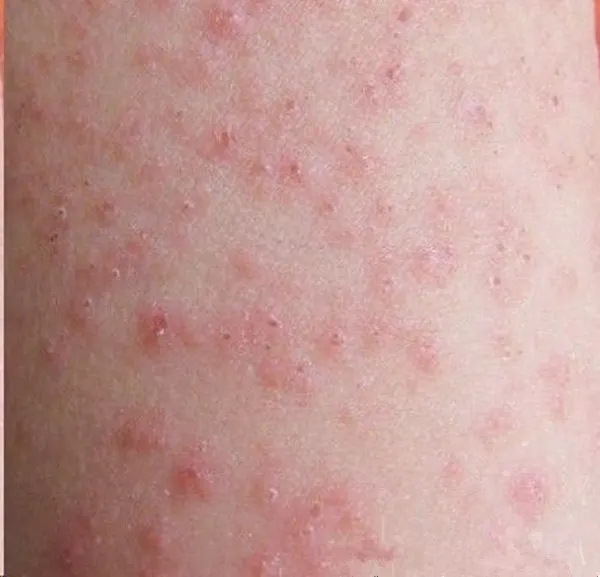 急性荨麻疹，你需要知道的一切