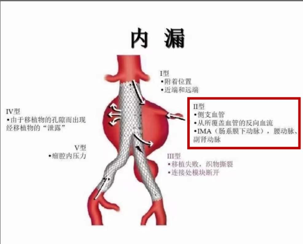 震惊！腹主动脉瘤危机：你所需要知道的一切