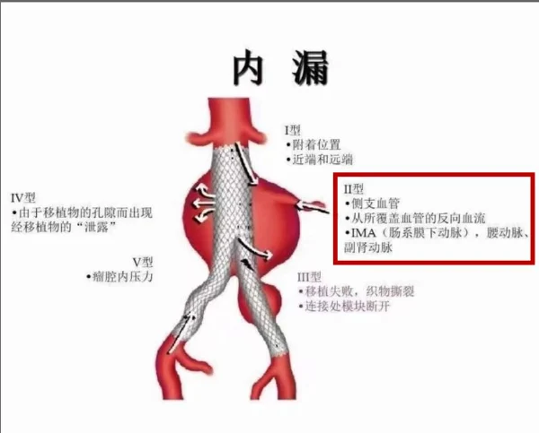 震惊！腹主动脉瘤危机：你所需要知道的一切