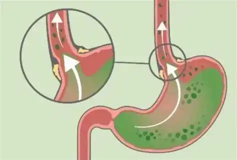 了解反流性疾病:胃炎与食管炎的全面解析