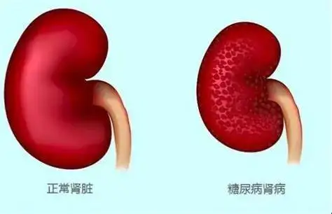 【科学探秘】糖尿病肾病——潜伏在身边的隐形杀手